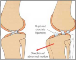 Instability from CrCL disease results in abnormal forward motion of the lower part of the knee 