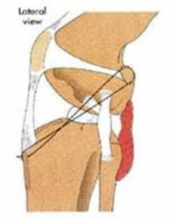 Lateral Fabellotibial suture diagram