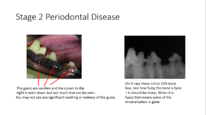 Stage 2 periodontal disease showing swollen gums and 0-25% bone loss