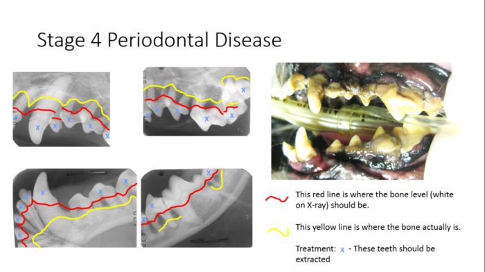 Stage 4 periodontal disease showing significant bone loss and require tooth extraction