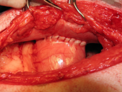 This is a photo of a completed gastropexy - you can see the suture line where the stomach has been attached to the abdominal wall